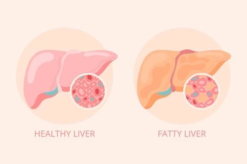 fatty-liver-diagnosis-ai-project