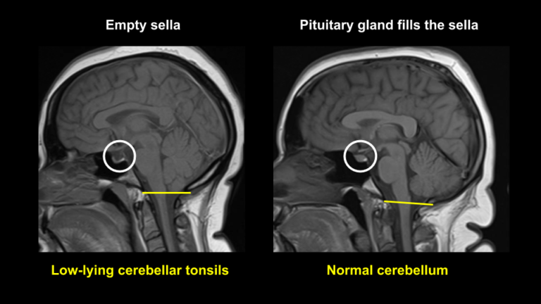 intracranial-hemorrhage-detection-768x432